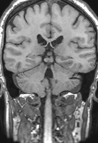MRI of brain
