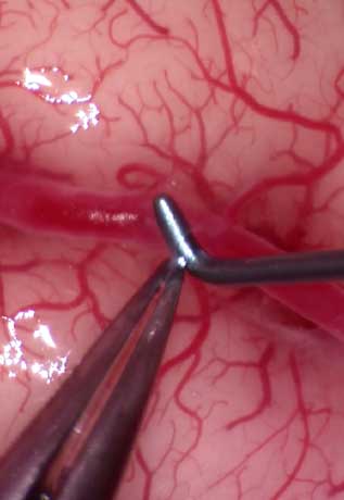 close up of brain surgery