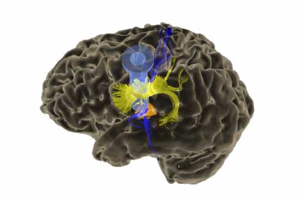 brain with some color and showing path to lesion