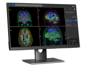 Synaptive Medical's BrightMatter Plan uses diffusion tensor imaging (DTI), a type of MRI, to map out white matter tracts in a patient’s brain. The software automatically sends imaging information to a laptop in the physician’s office and generates a 3D image of the brain. With that image, surgeons can determine the most effective route for their surgical plan.