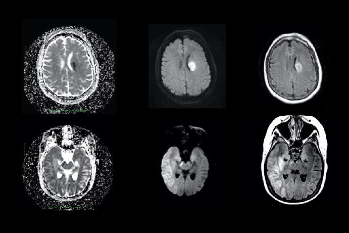 four MRI brain scans on a black background