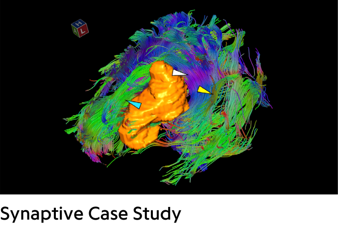 colorful brain with tumor in orange