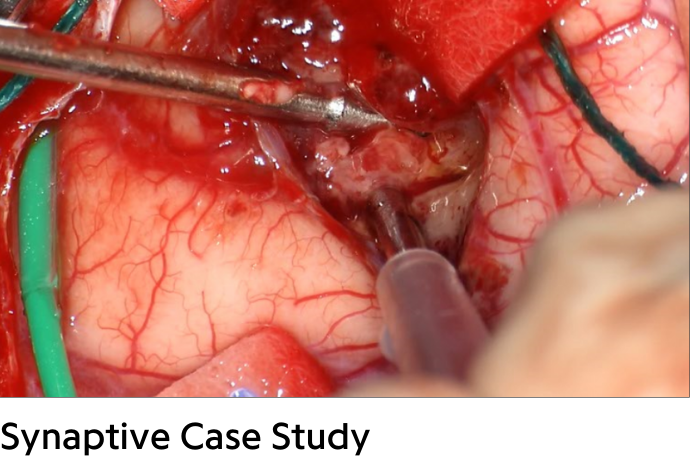 close up of brain surgery