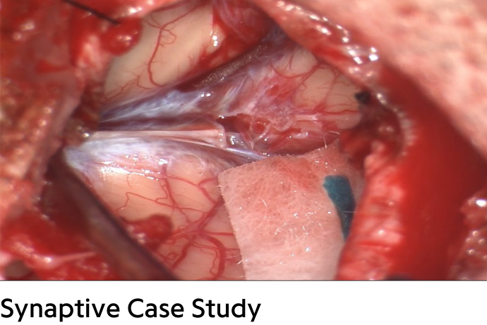 close up of brain surgery